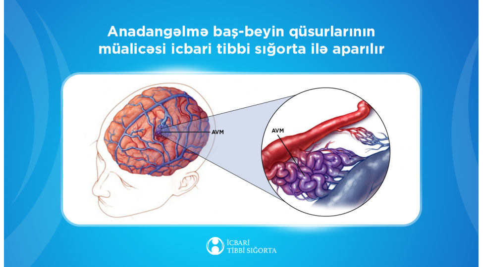 anadangelme-bash-beyin-qusurlarinin-achiq-usulla-emeliyyati-icbari-tibbi-sigorta-ile-icra-olunur