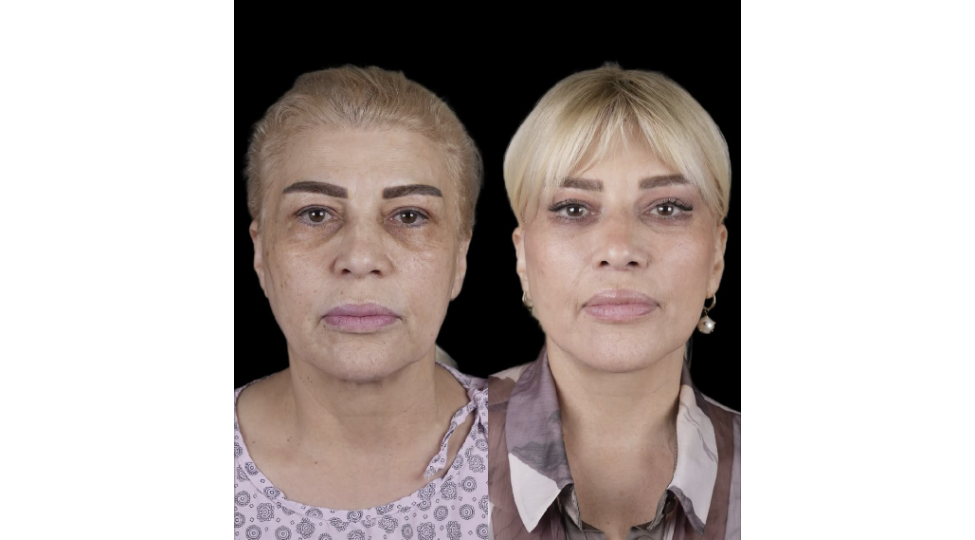 metanet-isgenderli-plastik-emeliyyat-etdirib