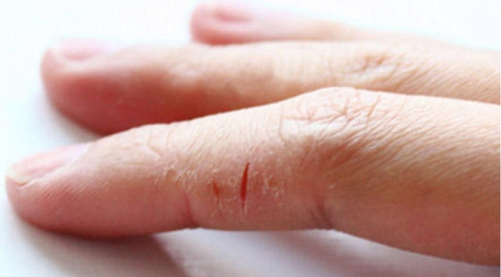 qishda-ellerinizin-derisi-chatlayir-ele-ise