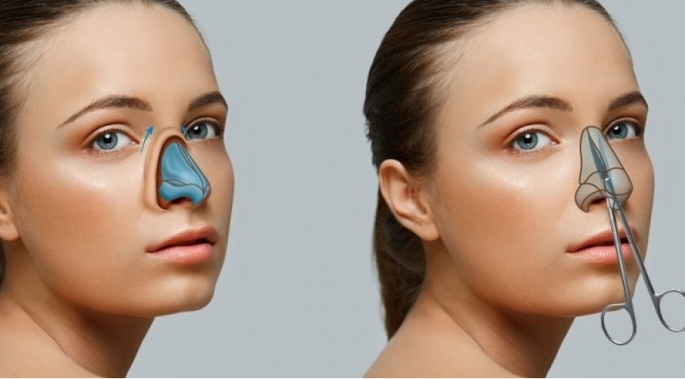 rinoplastikadan-sonra-bunlari-etmeyin