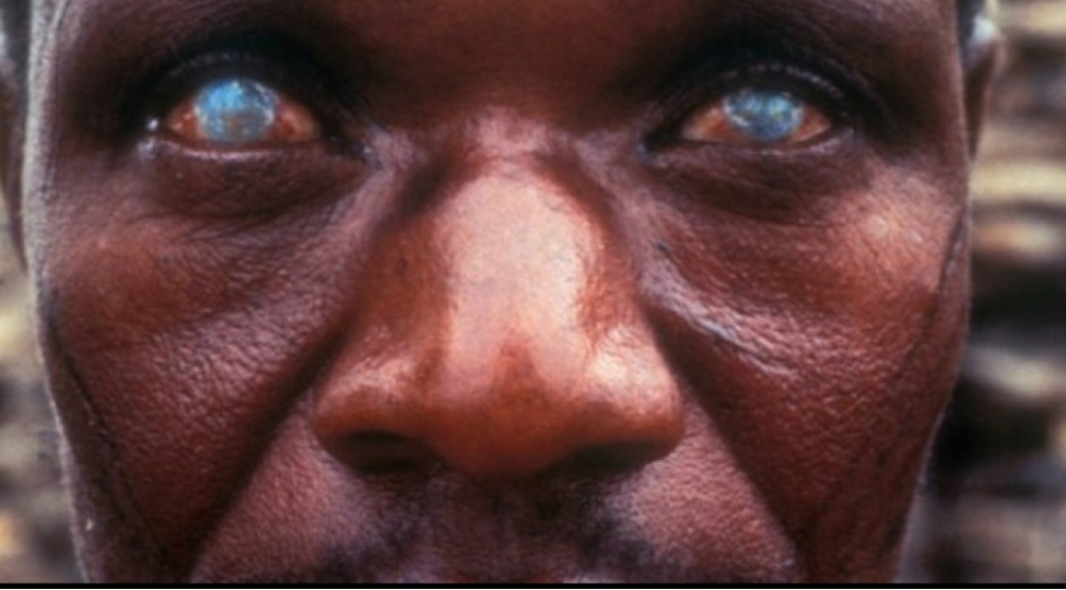 insan-bedeninde-yashaya-bilen-10-en-qorxulu-parazitfoto