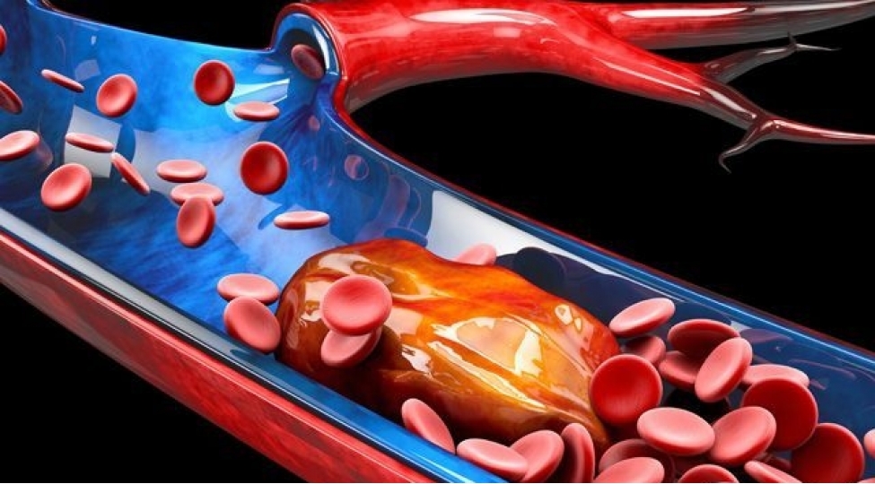 urek-bash-ayaqda-damarlarin-tutuldugunu-gosteren-3-elamet