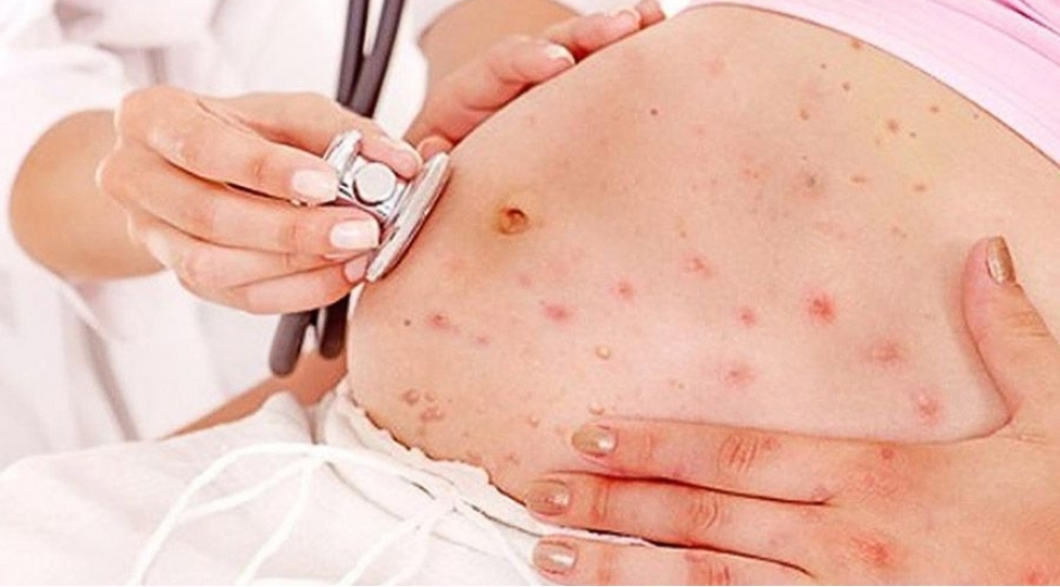 ust-den-meymunchicheyi-ile-bagli-hamilelere-xeberdarliq