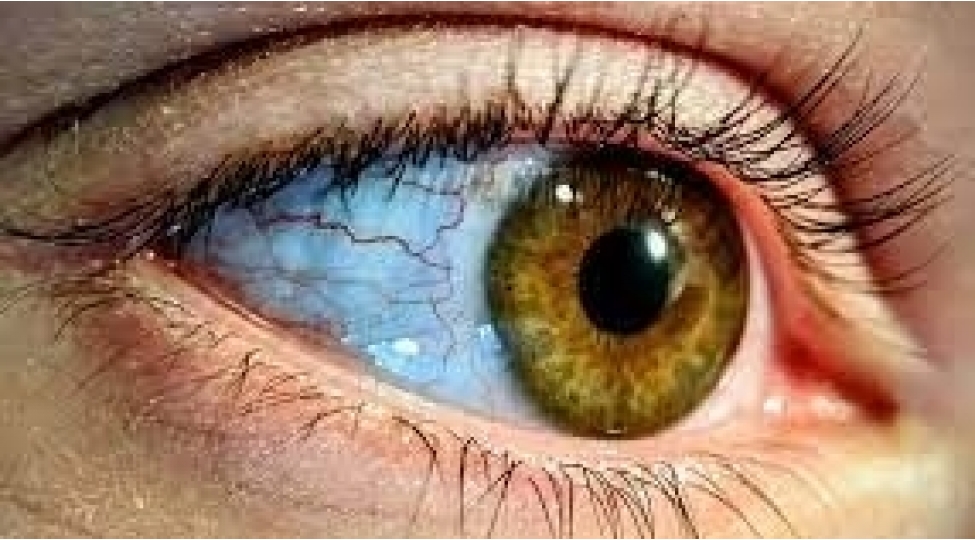 tezyiq-ve-sheker-qlaukomaya-sebeb-ola-biler