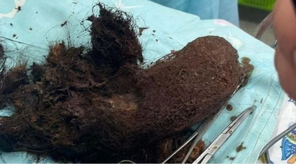 12-yashli-qizin-medesinden-chixanlardehshete-getirdi