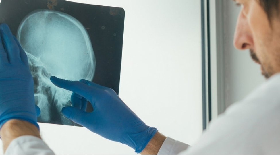 taninmish-nevroloq-insultun-bashlangic-elametlerini-sadalayib