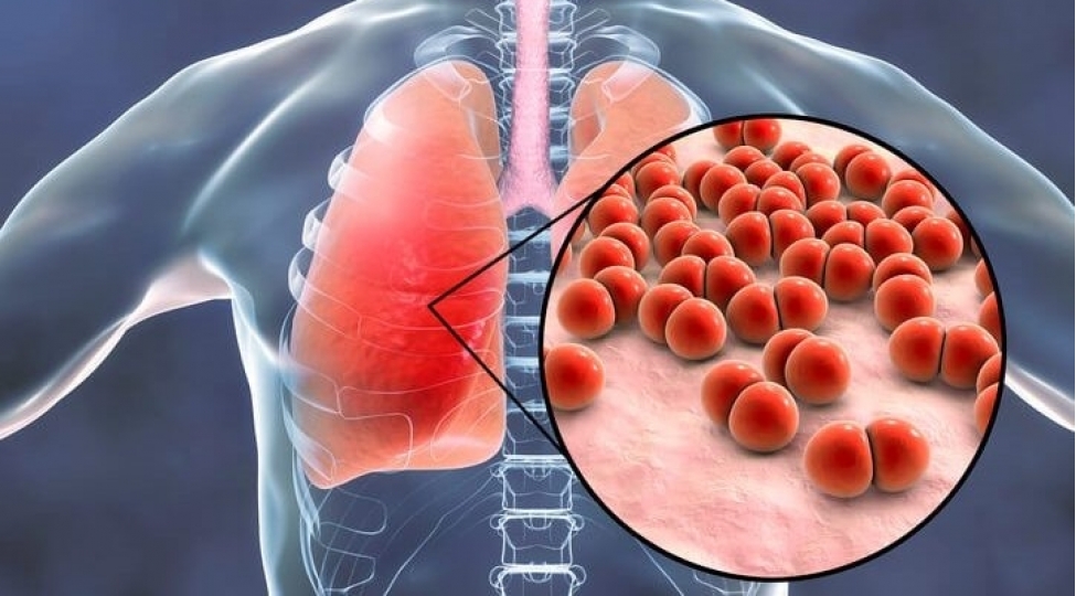 olumcul-proqnoz-pnevmokok