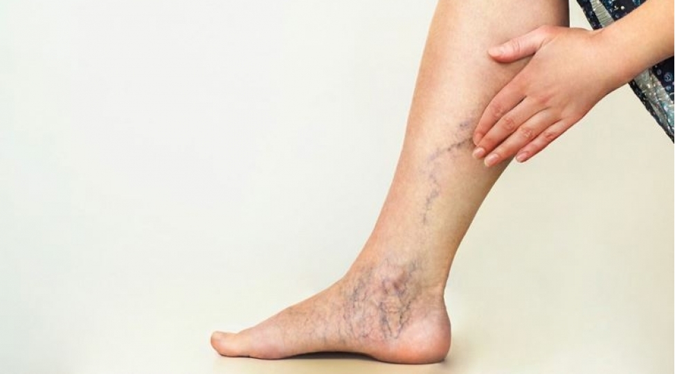 varikoz-uchun-eks-gosterishler-bunu-her-kes-bilmelidir