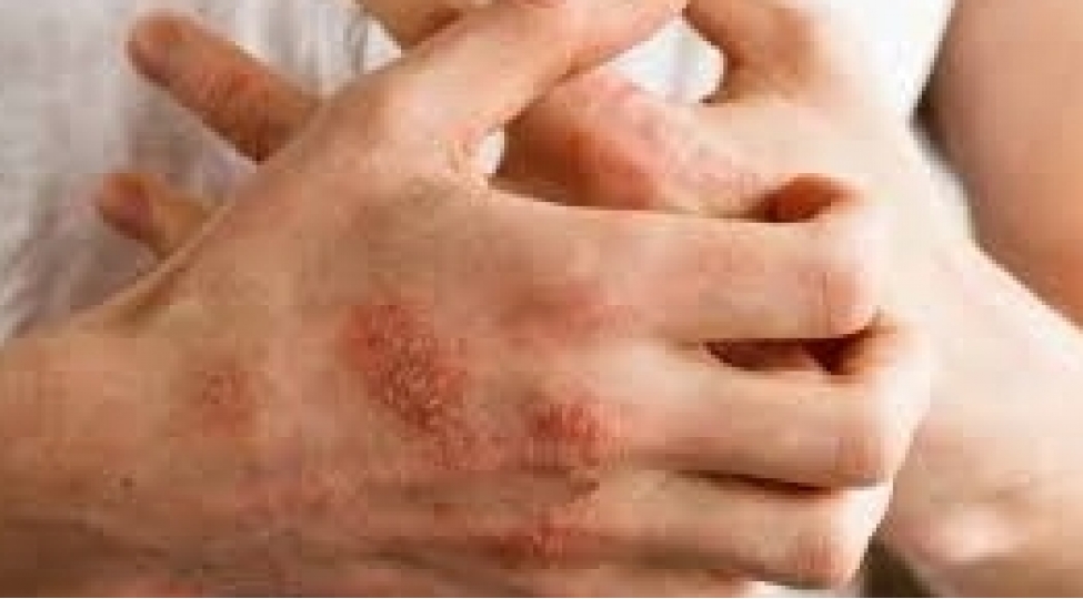 800-den-chox-ixtioz-xestesi-dispanser-qeydiyyatindadir